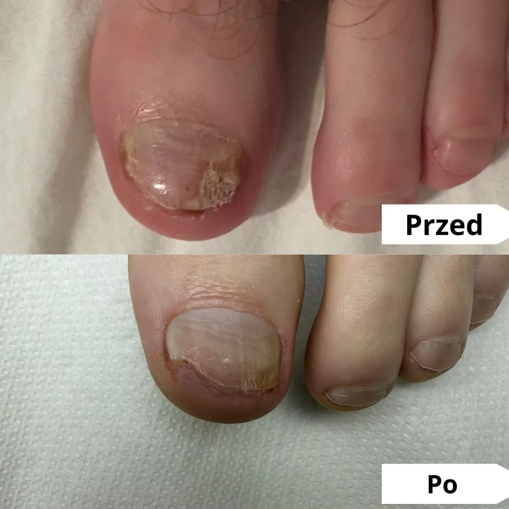 Paznokieć zmieniony chorobowo — przed i po opracowaniu