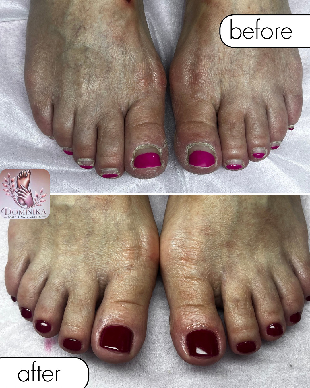 Metamorfoza — pedicure podologiczny