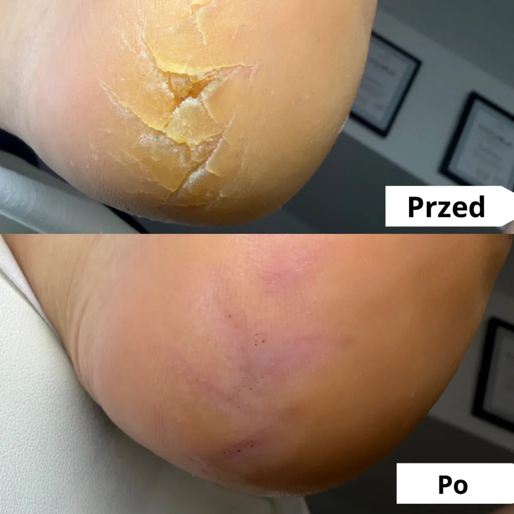 Pękająca pięta — przed i po zabiegu podologicznym